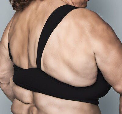 康霈 CBL-514 竇根氏症二期成果獲登國際權威期刊《JAAD International》