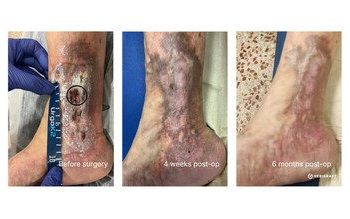 VERIGRAFT 將其首個有望根治慢性靜脈功能不全的療法，推進至關鍵的第 II/III 期臨床試驗